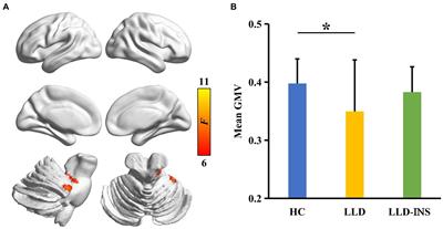 A voxel-based morphometry investigation of brain structure variations in late-life depression with insomnia